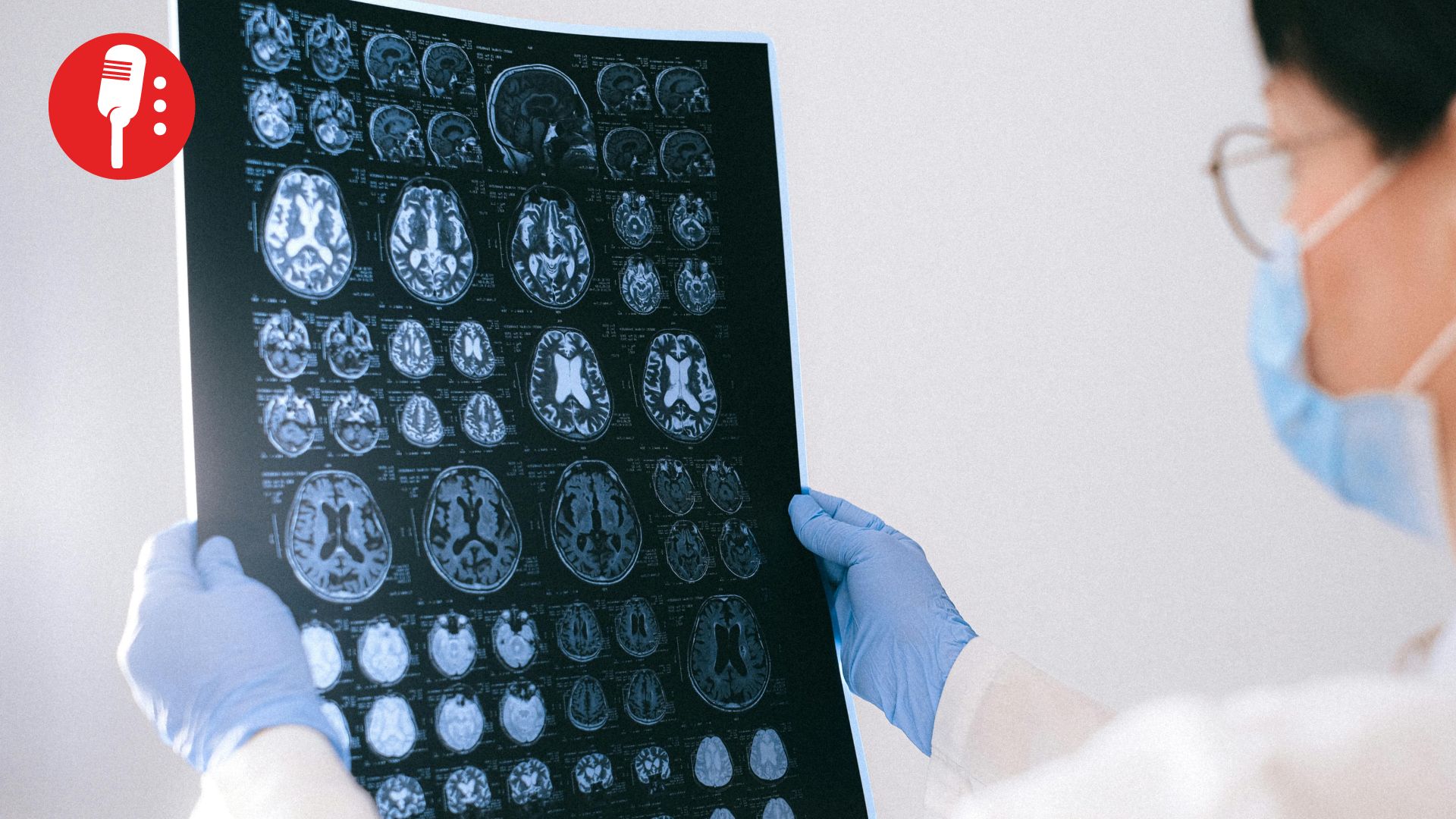 Forma del cerebro podría revelar riesgo de Alzheimer antes de los síntomas